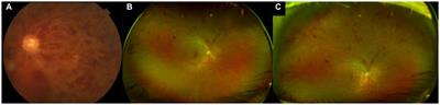 Clinical utility of ultra-widefield fluorescein angiography and optical coherence tomography angiography for retinal vein occlusions